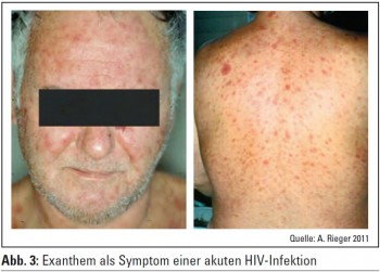 Update Hiv Medmedia