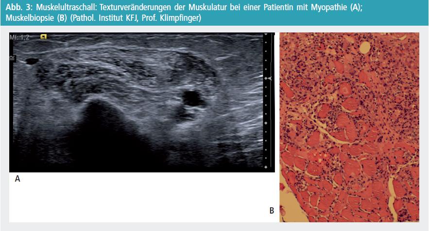 Faszikulationen der zunge