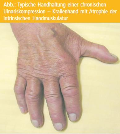 Besserung op nach ulnaris keine Die wichtigsten