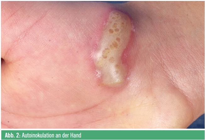 Herpes Labialis Neue Therapeutische Moglichkeiten Medmedia