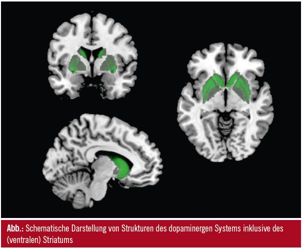 Studie zu Gehirnstrukturen bei Sucht: Was stellt Alkohol in unserem Kopf  an?, Ernährung, Gesundheit, Verstehen