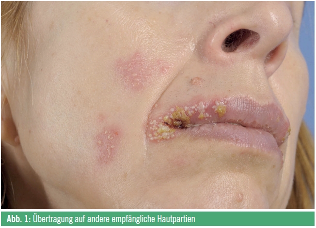 Hidradenitis suppurativa Picture Image on MedicineNet.com