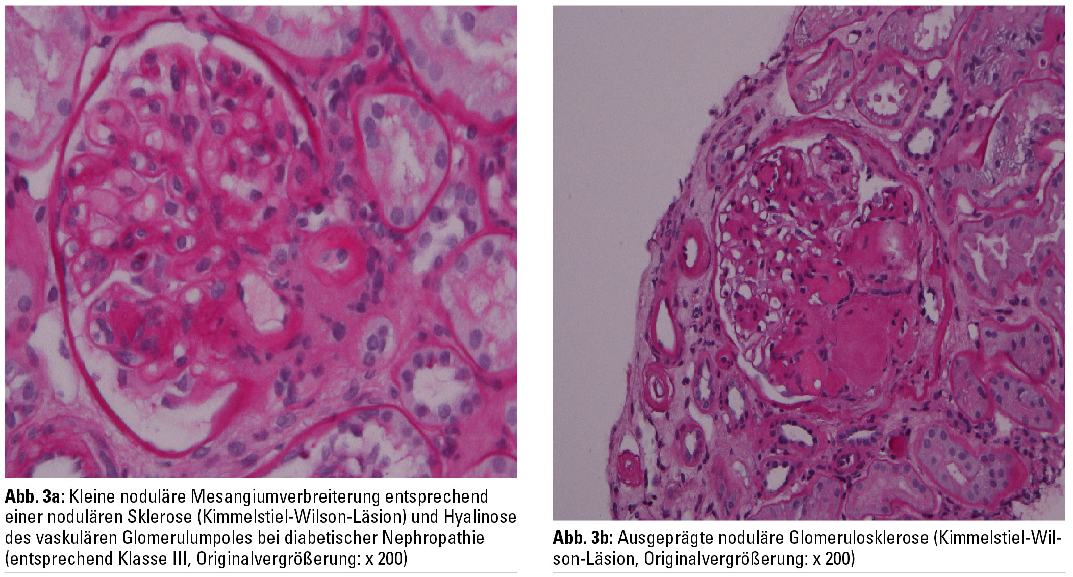Klassifikation der diabetischen Nephropathie NephroScript MedMedia