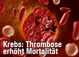 Tumorassoziierte Thrombosen erhöhen die Mortalität