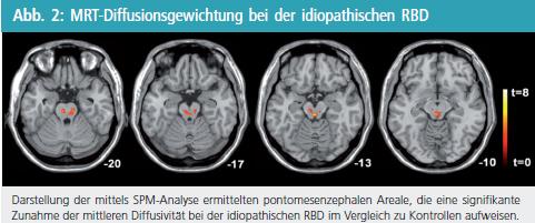 Rem Schlaf Verhaltensstorung Rbd Und Morbus Parkinson Was Gibt Es Neues Medmedia