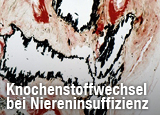 Knochenstoffwechsel bei chronischer Niereninsuffizienz