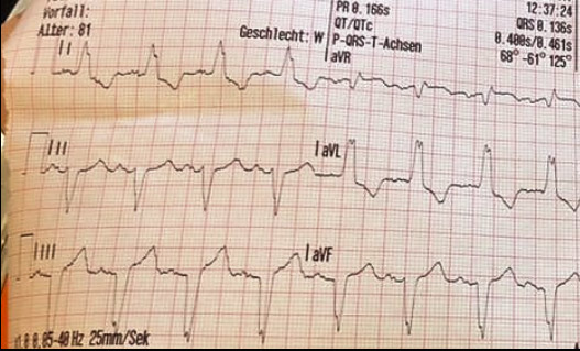 Tipps Fur Medizinstudenten Ekg Systematisch Beurteilen Nextdoc