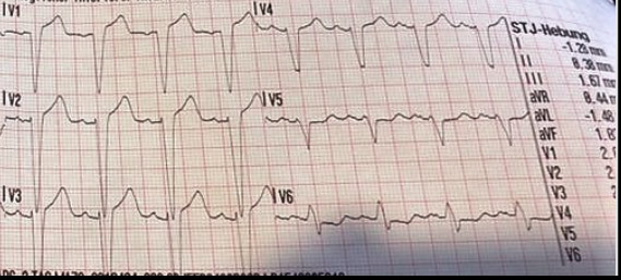 Tipps Fur Medizinstudenten Ekg Systematisch Beurteilen Nextdoc