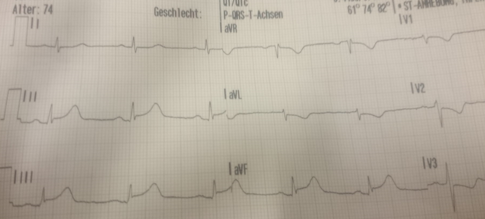 Tipps Fur Medizinstudenten Ekg Systematisch Beurteilen Nextdoc