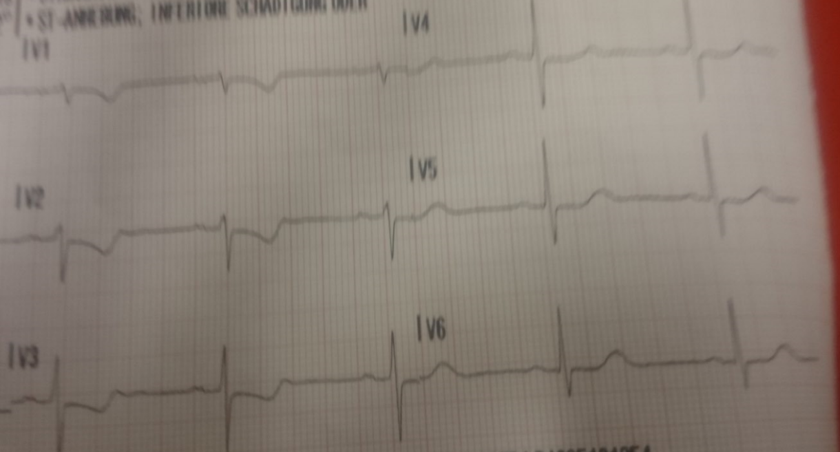 Tipps Fur Medizinstudenten Ekg Systematisch Beurteilen Nextdoc