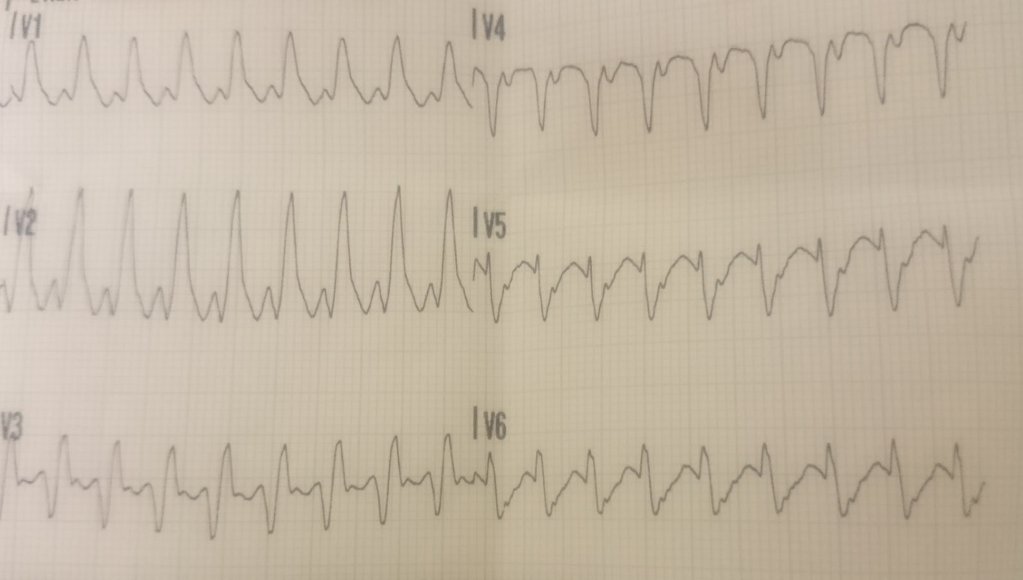 Tipps Fur Medizinstudenten Ekg Systematisch Beurteilen Nextdoc