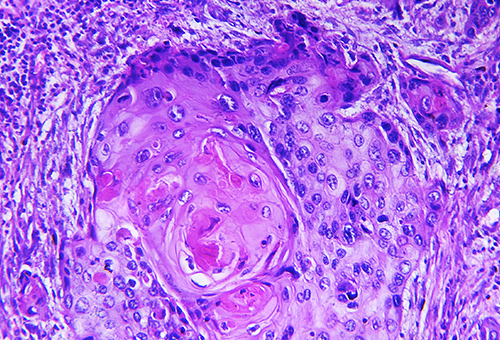 Cemiplimab beim kutanen Plattenepithelkarzinom