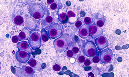 Multiples Myelom