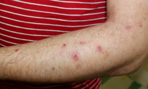 Ein Fall von Prurigo nodularis bei einem Mann