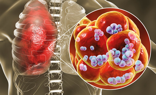 Trotz COVID-19 Pneumokokken nicht unterschätzen