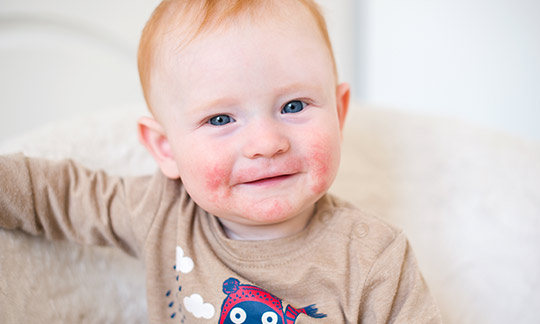 Atopische Dermatitis
