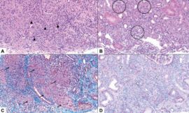 Histologische Beispiele verschiedener tubulointerstitieller Nephritiden